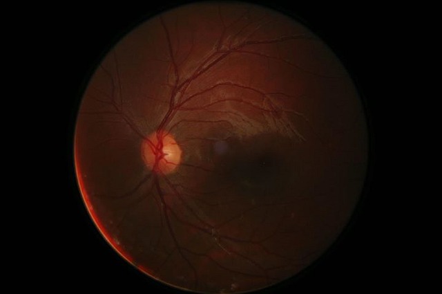 retinal photography
