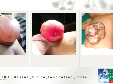 ” Accessibility for All ” – Celebrating World Spina Bifida Awareness Day